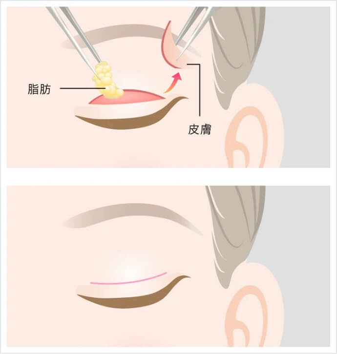全切開法
