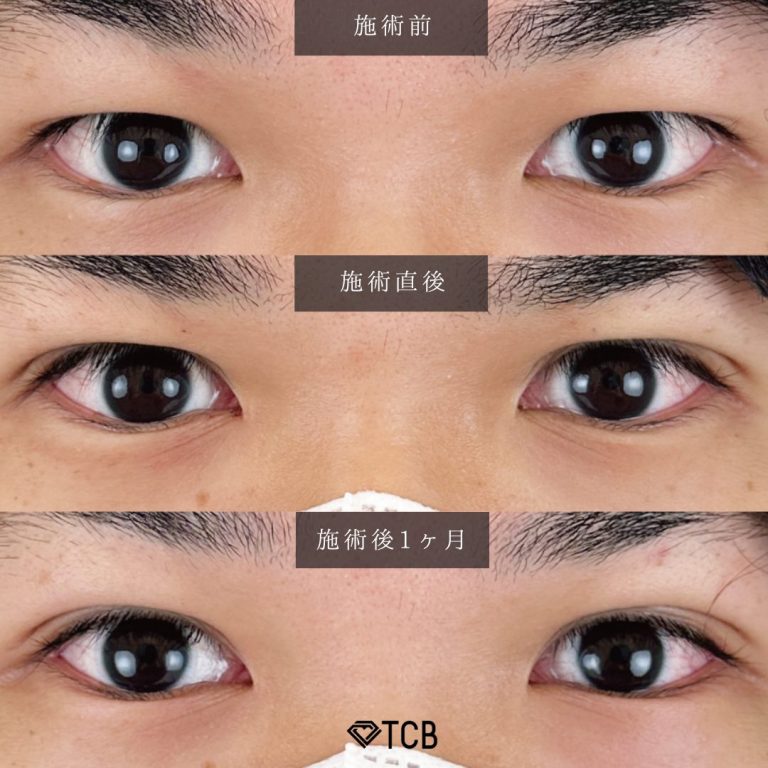 TCB二重術