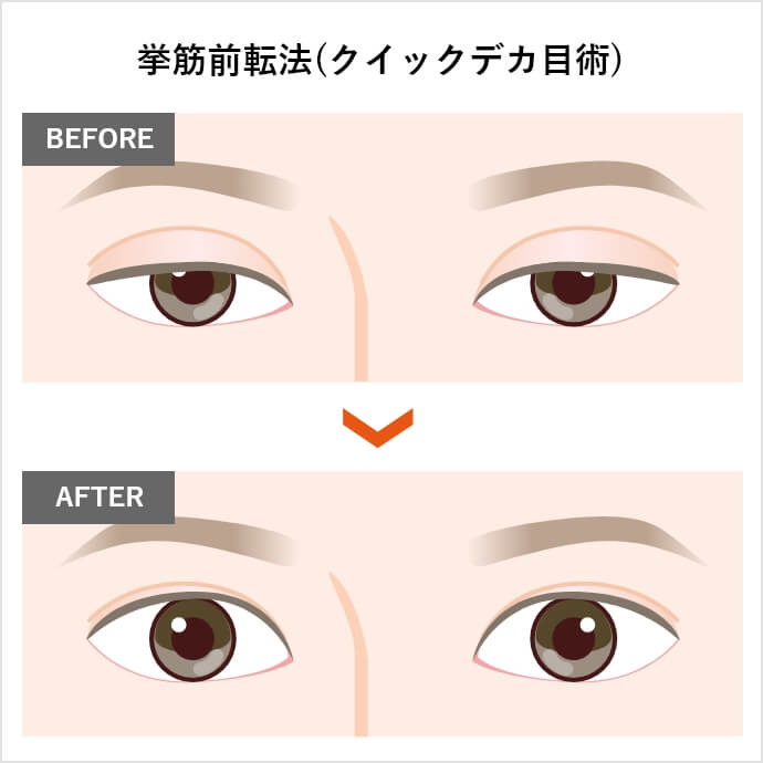 挙筋前転法(クイックデカ目術)
