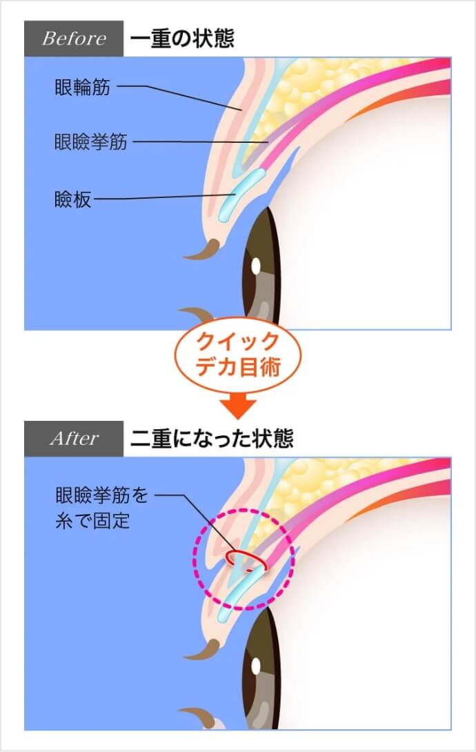 一重の方は二重に