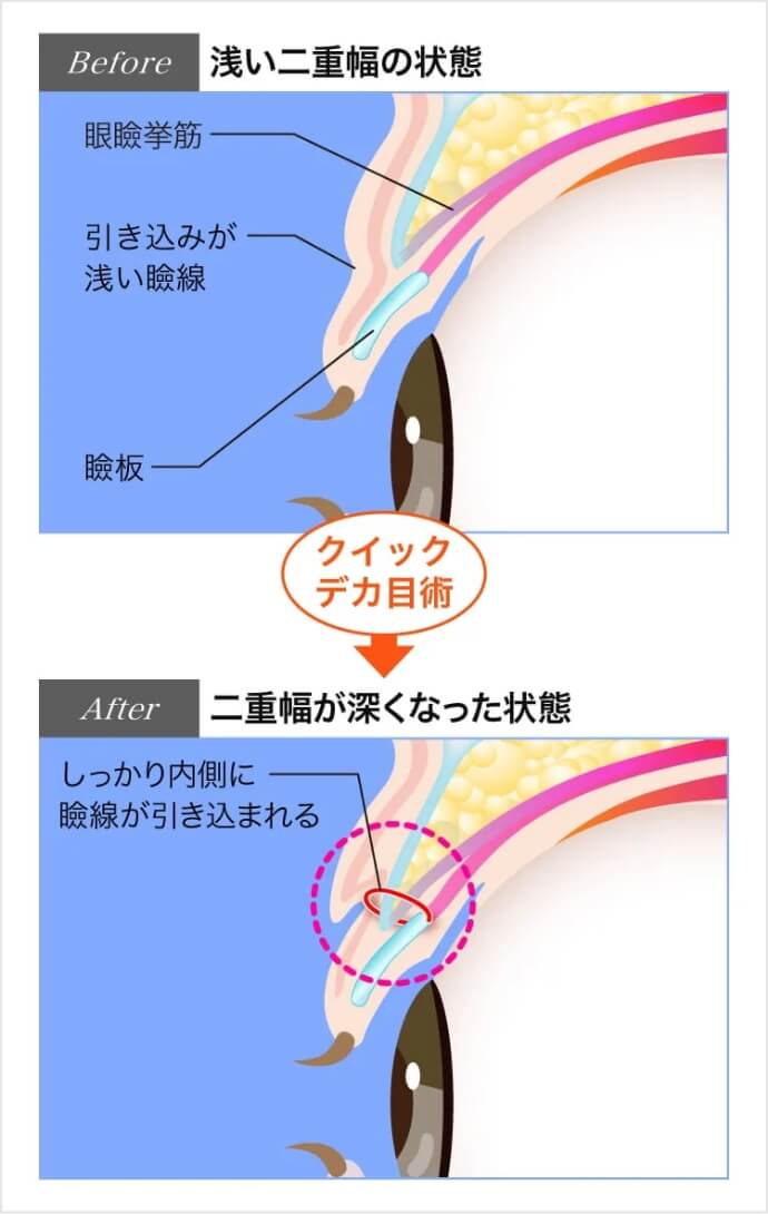 奥二重の方はくっきり二重に