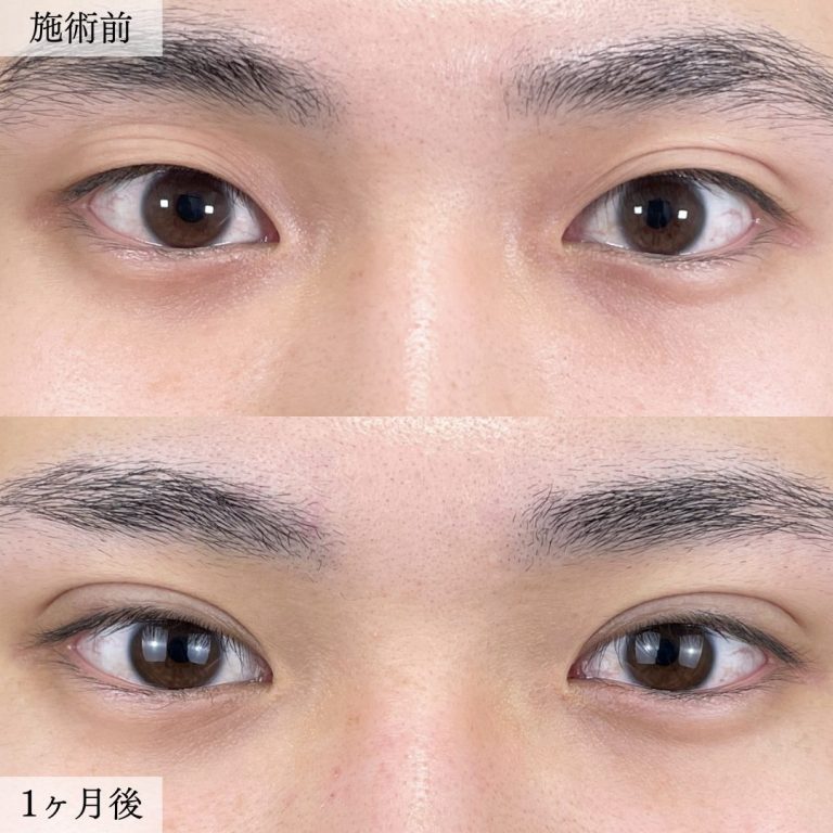 TCB二重術