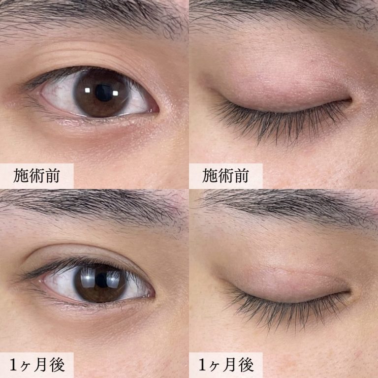 TCB二重術