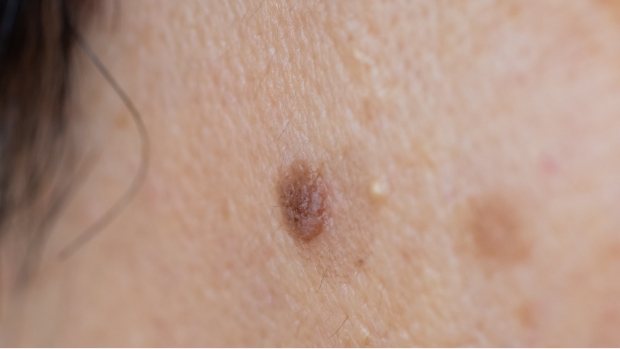 ほくろ