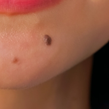 ●色素性母斑（しきそせいぼはん）