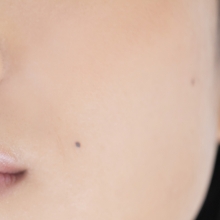 ●単純黒子（たんじゅんこくし）