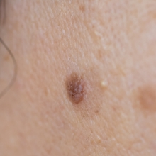 ●脂漏性角化症（老人性イボ）