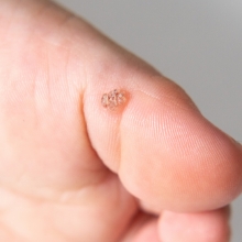 ●尋常性疣贅（ウイルス性イボ）