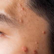 ●扁平疣贅（へんぺいゆうぜい）