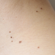 ●アクロコルドン（軟性線維腫）