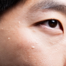 ●稗粒腫（はいりゅうしゅ）