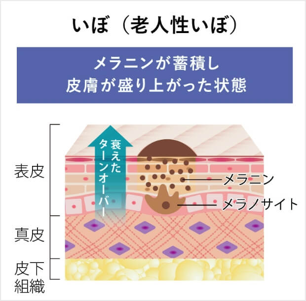 いぼ（老人性いぼ）