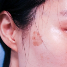 ●肝斑（かんぱん）