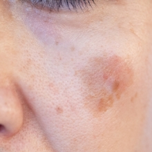 ●老人性色素斑（ろうじんせいしきそはん）