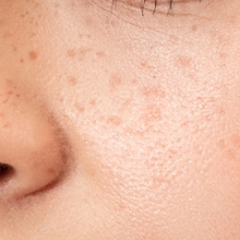 ●雀卵斑（そばかす）