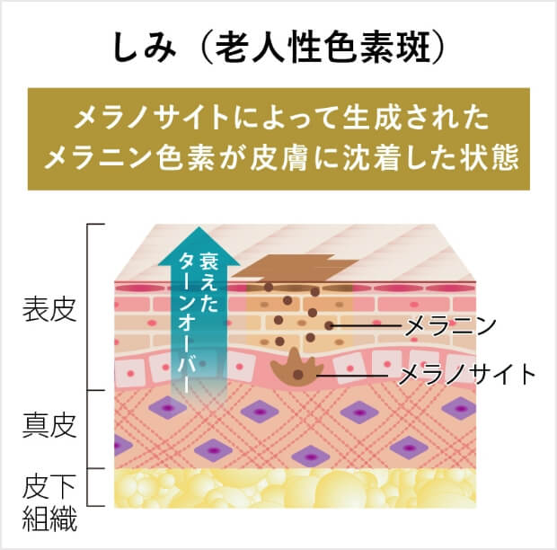 しみ（老人性色素斑）