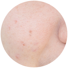 ほくろ・いぼ除去の注意点2