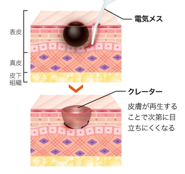 電気メスによる電気分解法