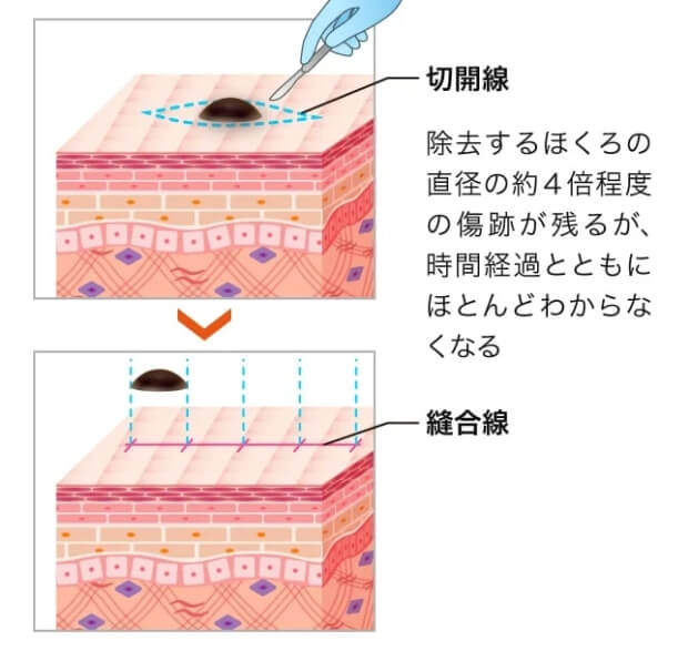 メスによる切開法