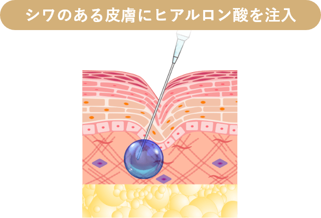 シワのある皮膚にヒアルロン酸を注入