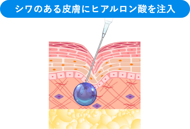 シワのある皮膚にヒアルロン酸を注入