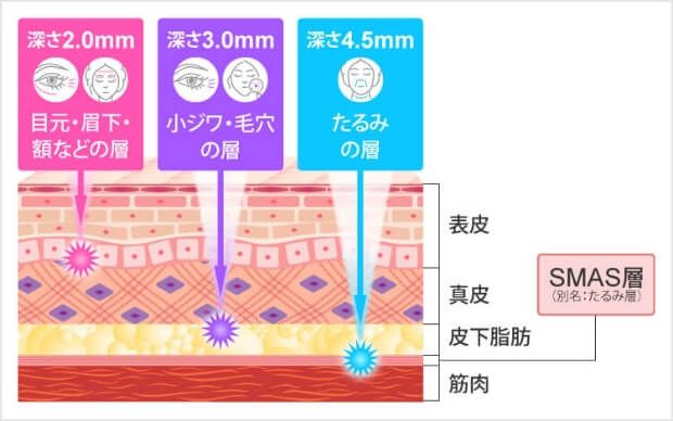 SMAS層の図