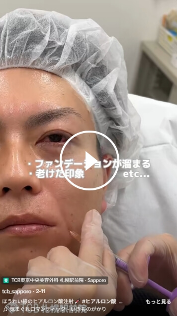 ヒアルロン酸で気になるシワ軽減！