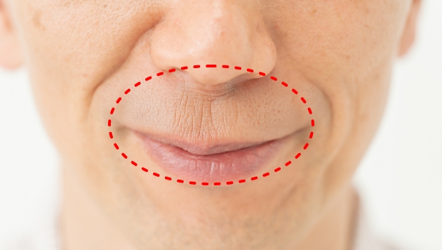人中（鼻と上唇の間）にできる縦ジワ