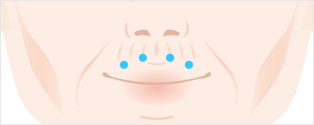 口元のシワボトックス注射とは