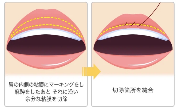 スマートリップ(たらこ唇整形)施術