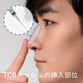 TCBメッシュの挿入イメージ