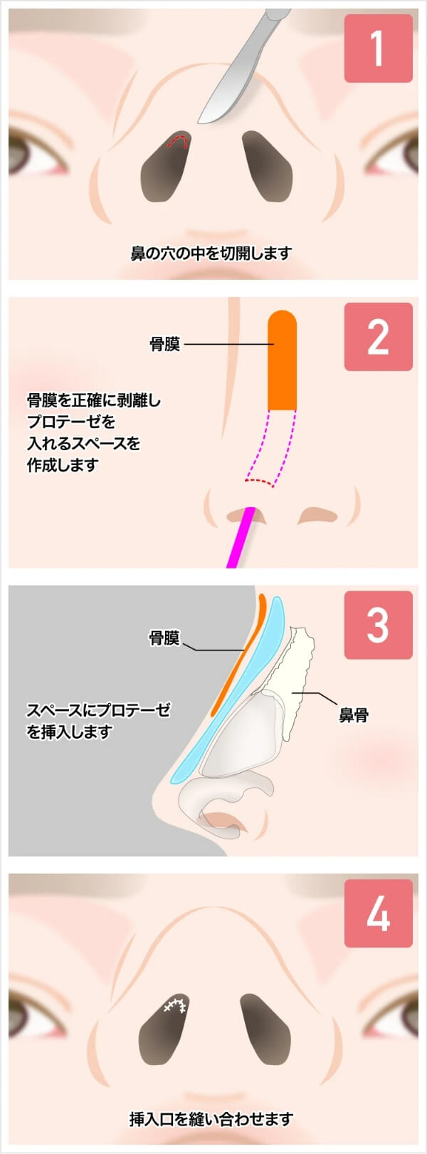 TCBではI型のプロテーゼを使用