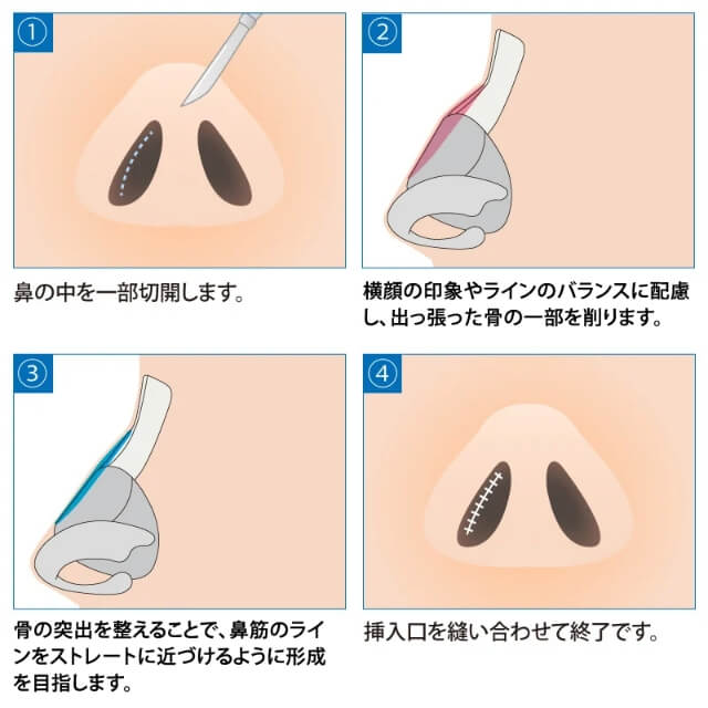 鷲鼻修正(骨削り術)
