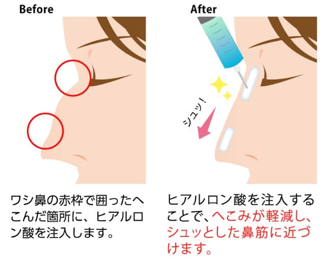 鷲鼻修正(鼻のヒアルロン酸注入)