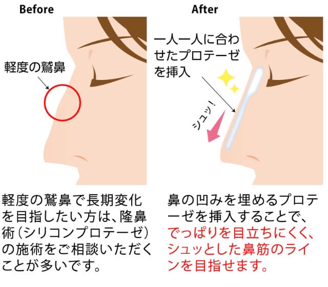 鷲鼻修正(シリコンプロテーゼ)