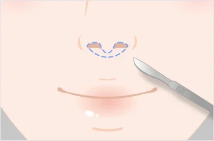 切開・縫合