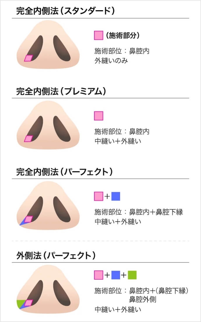 TCB式鼻翼縮小施術組み合わせ一覧