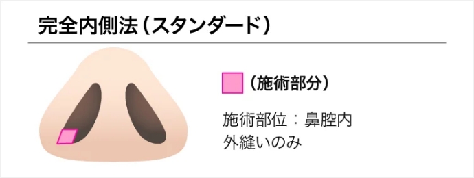TCB式鼻翼縮小(完全内側法）