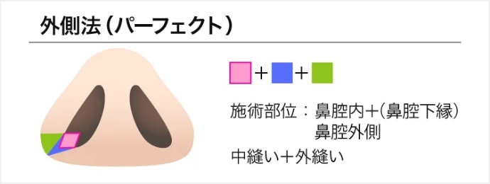 TCB式鼻翼縮小(外側法）