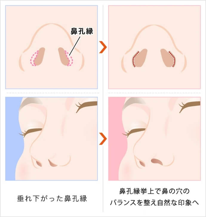 鼻の穴の形を自然なバランスに整え、不自然さを解消