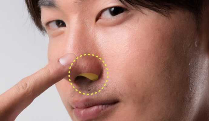 鼻孔縁とは？