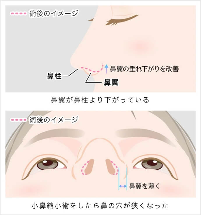 鼻孔縁挙上のイメージ
