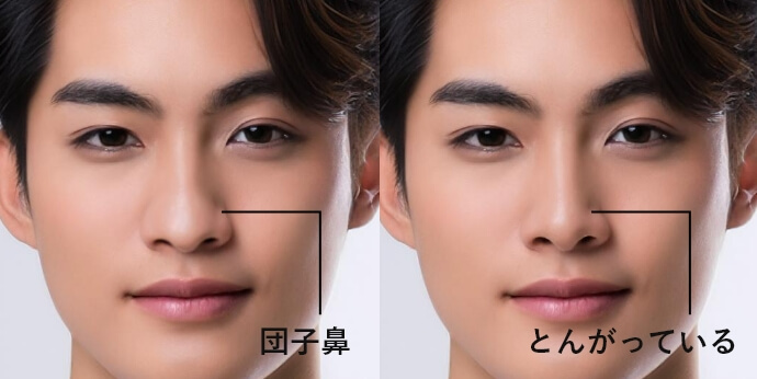 鼻尖形成とは