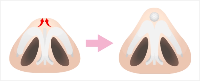 顔立ちに合わせたバランスの良い鼻先を形成