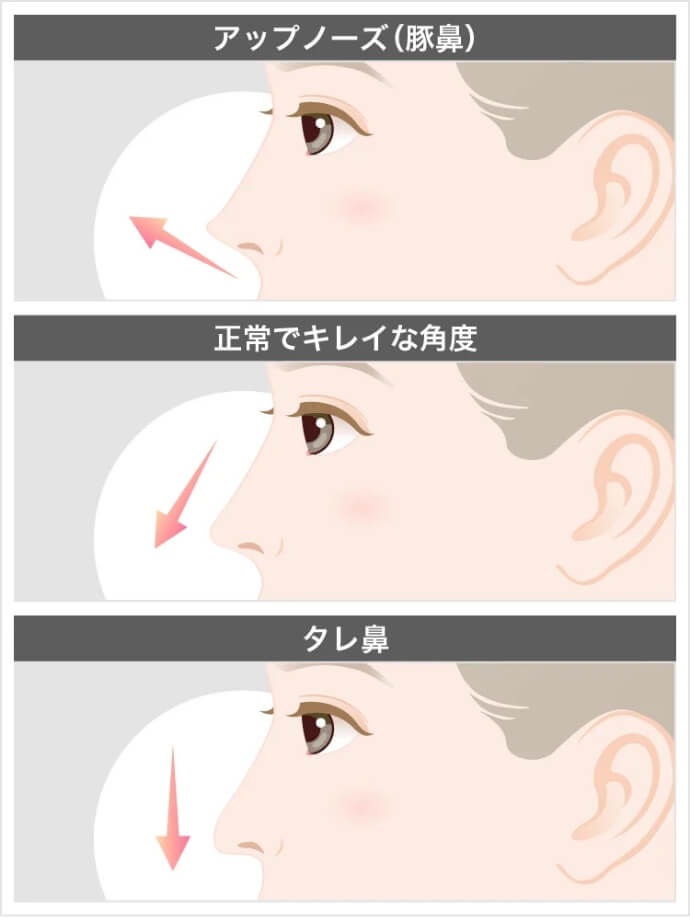 鼻中隔延長術と鼻尖形成の違い