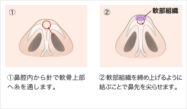 3D鼻尖形成（切らない鼻尖形成）