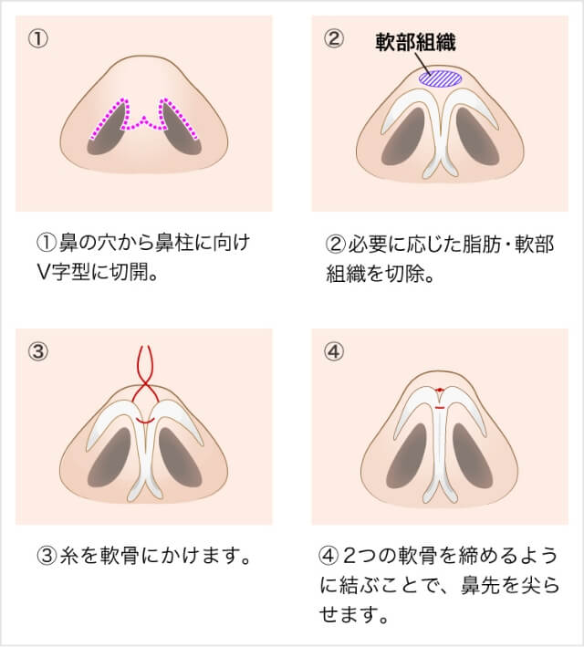 鼻尖形成オープン法（切開法）とは？