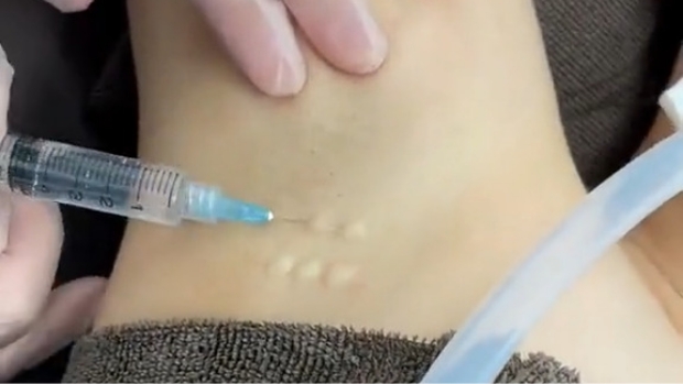 注射で短時間でできるわき汗対策