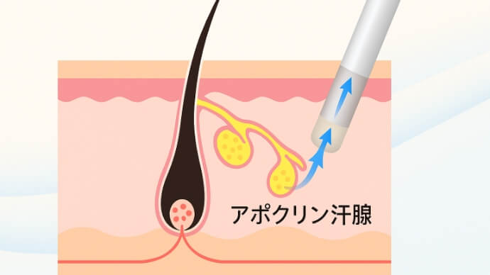 吸引シェービング法