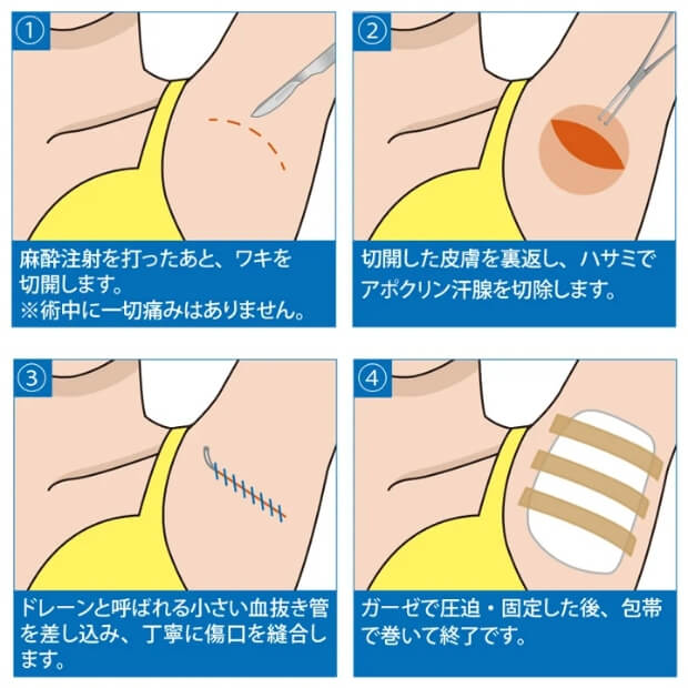 アポクリン汗腺を丁寧に除去